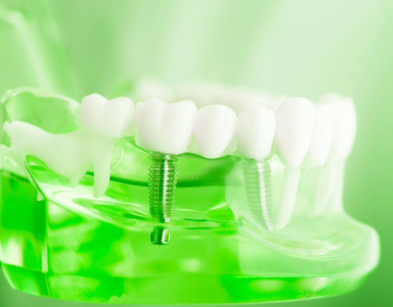implantaciya-dentium
