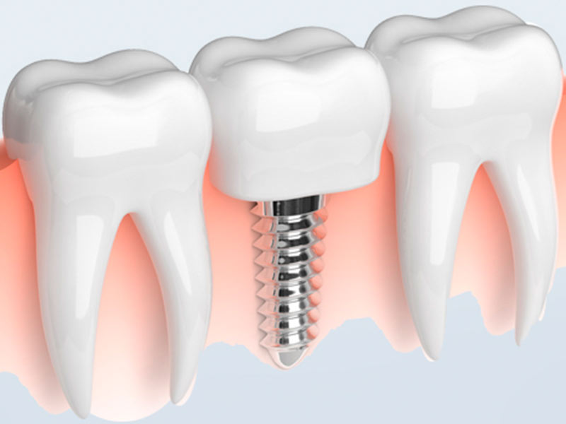 имплантация - вставить зуб, если зуб отсутствует
